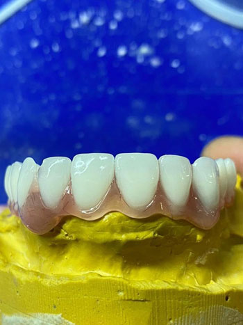 Sea Dent laboratuvarında protez hazırlık aşaması