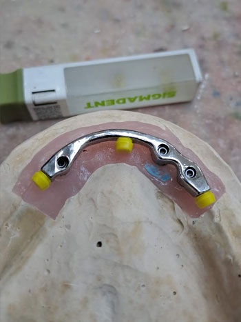 kombine protez Sea Dental İzmir