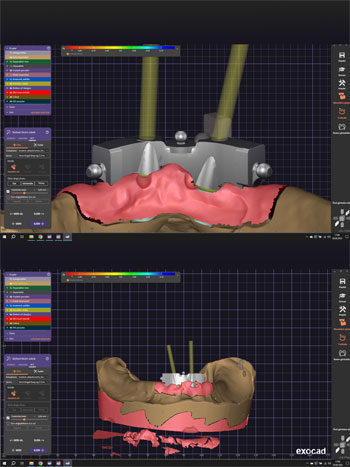 hassas tutuculu kombine protez İzmir