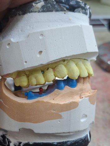 kombine protez üretimi İzmir