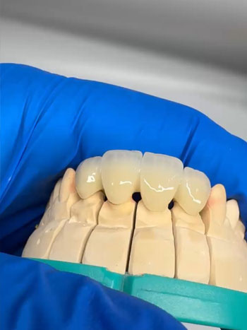 sabit protez Sea Dental İzmir